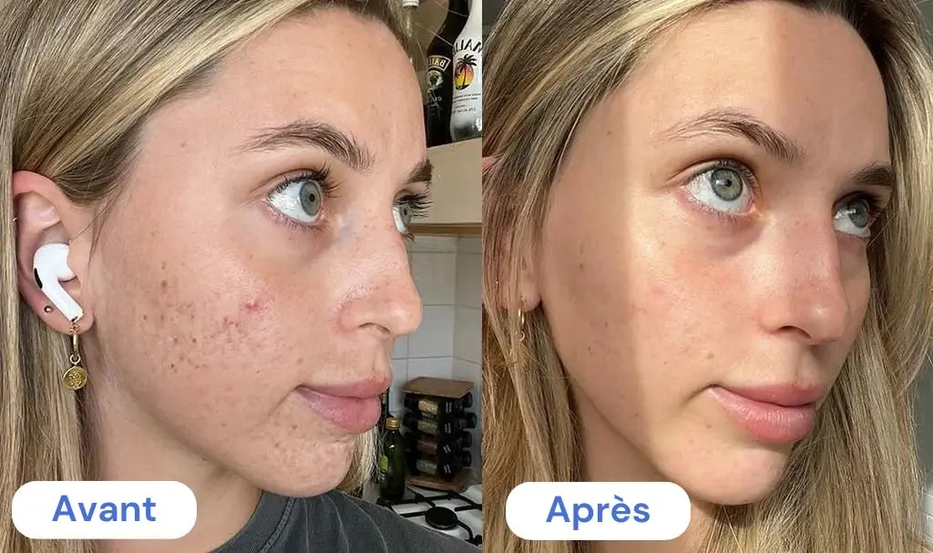 Cure de collagene avant apres